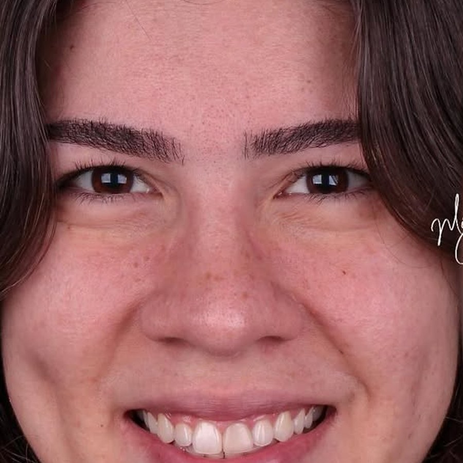 Caso 2 antes do tratamento com lentes dentárias