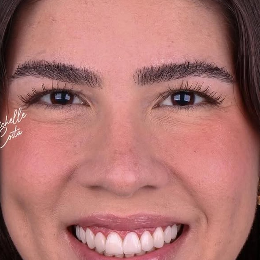 Caso 2 após tratamento com lentes dentárias