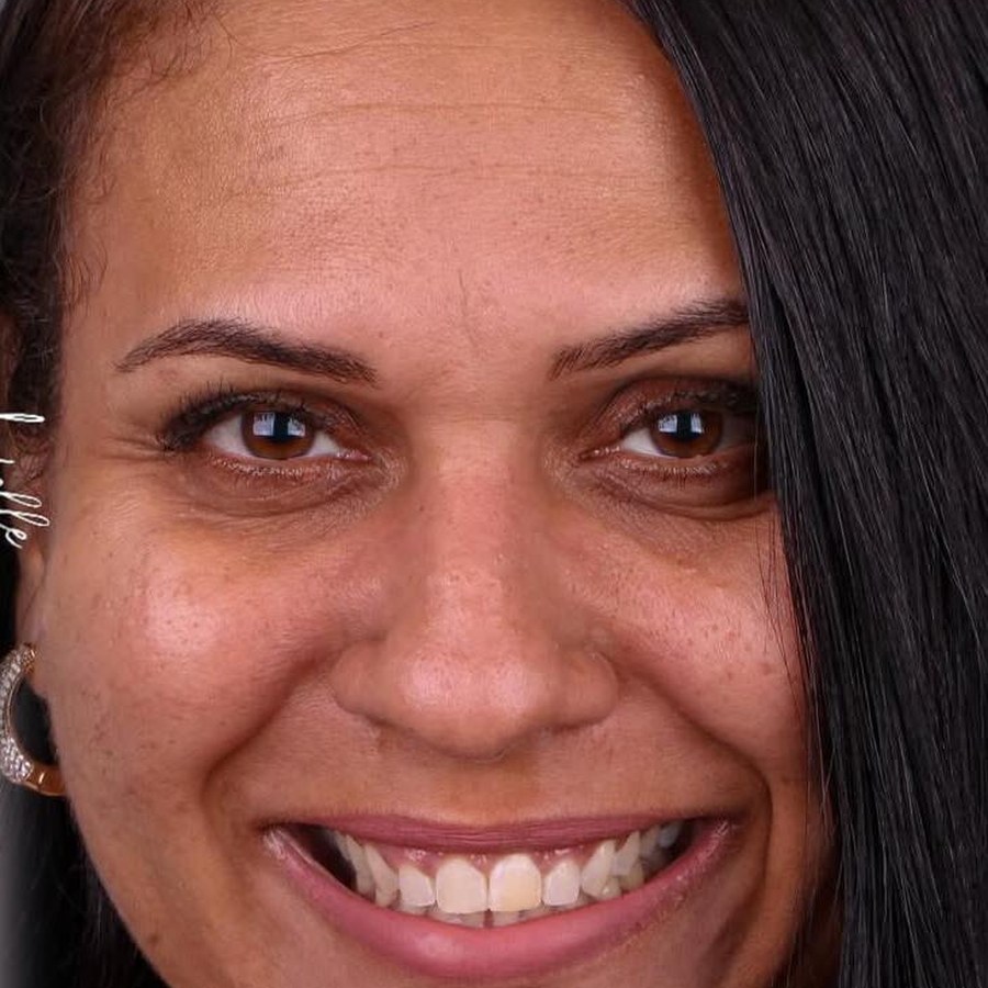 Caso 4 antes do tratamento com lentes dentárias