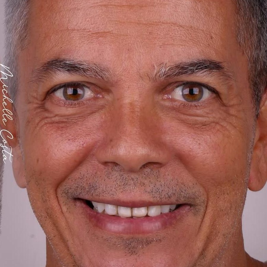 Caso 3 antes do tratamento com lentes dentárias