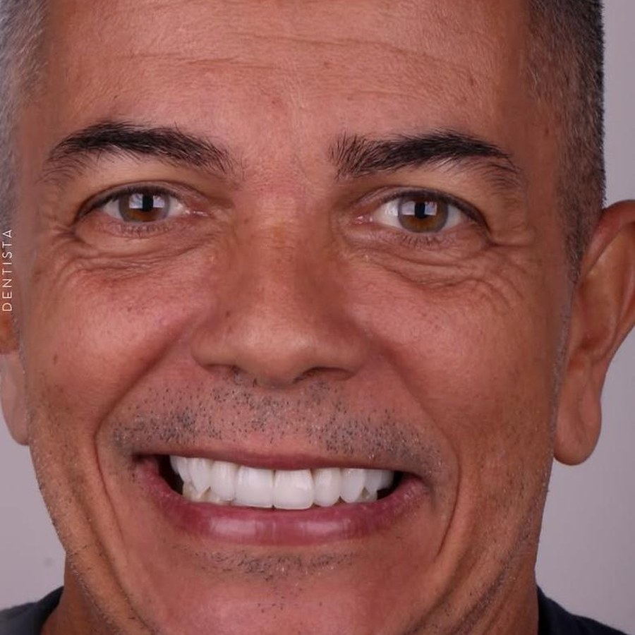 Caso 3 após tratamento com lentes dentárias