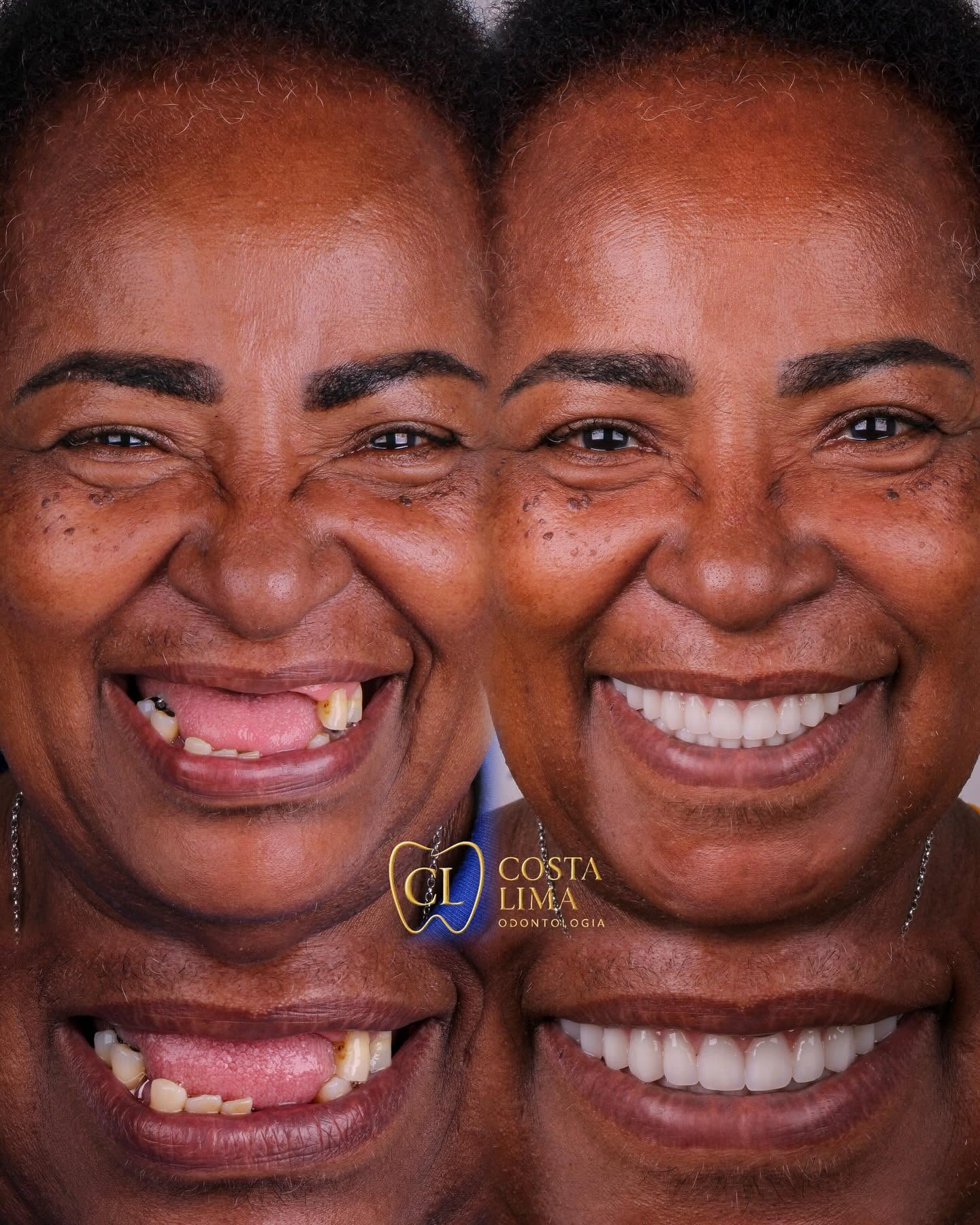 Antes e depois de reabilitação com implantes dentários na Costa Lima Odontologia