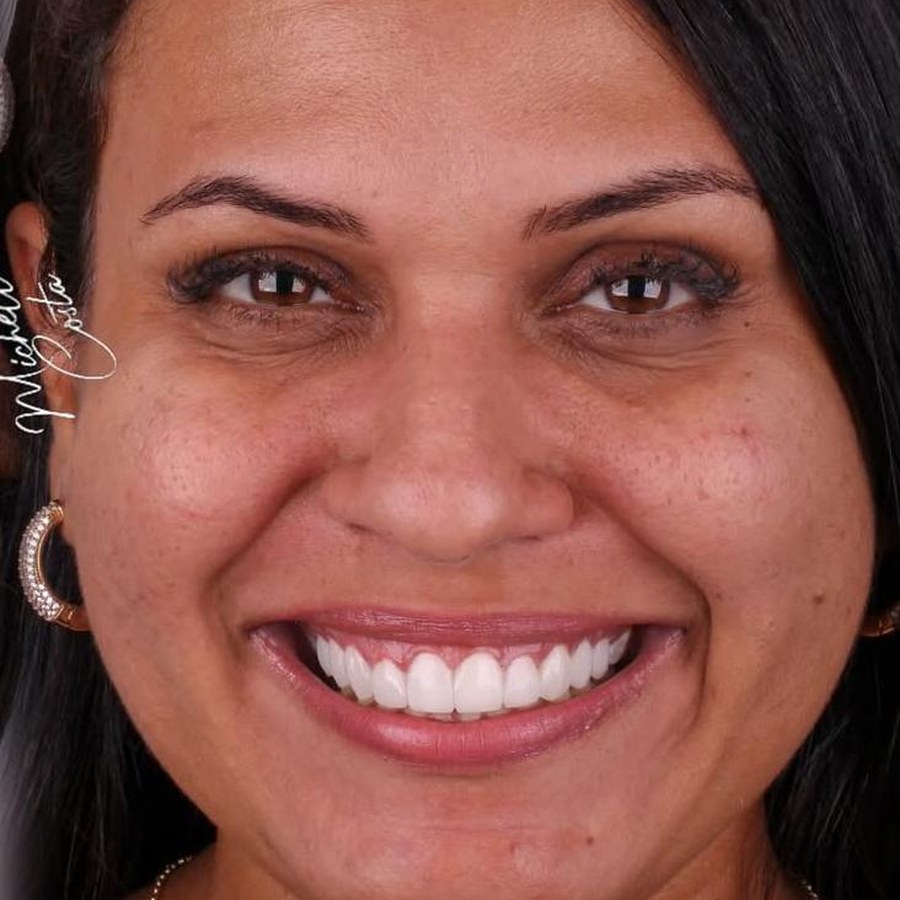 Caso 4 após tratamento com lentes dentárias